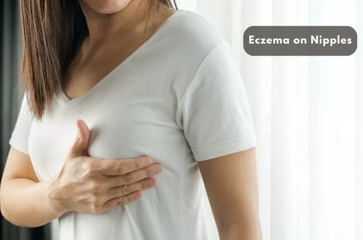 eczema on breast