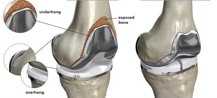 Managing Knee Pain: When is Surgery Necessary?