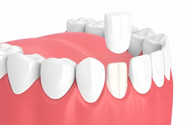 dental Implant Aberdeen