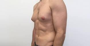 gynecomastia surgery price in Lahore