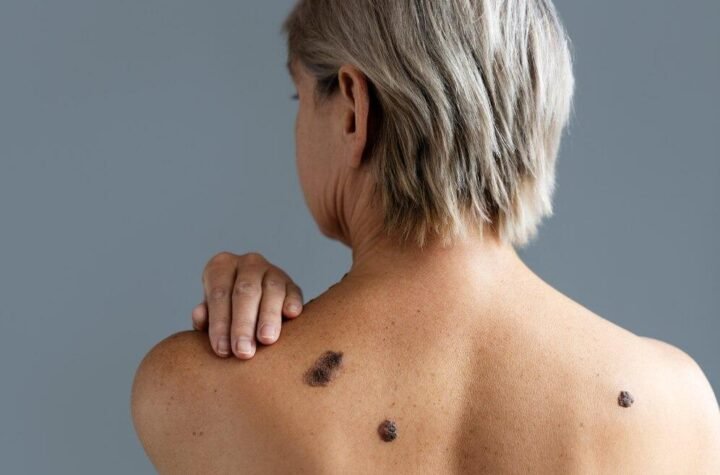 skin cancer spots