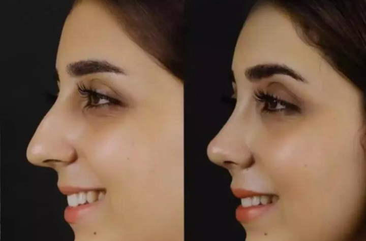 Rhinoplasty in Dubai: Fixing a Botched Surgery?