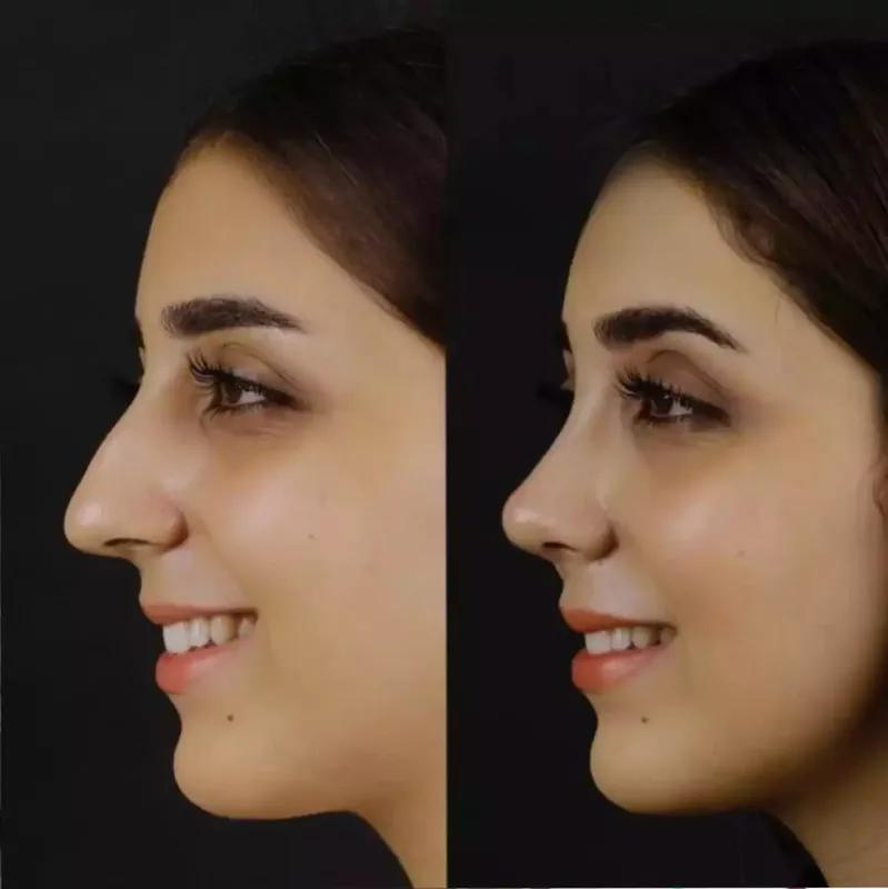 Rhinoplasty in Dubai: Fixing a Botched Surgery?