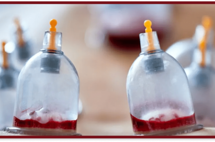 hijama