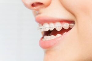 Teeth with Clear Braces in Karachi